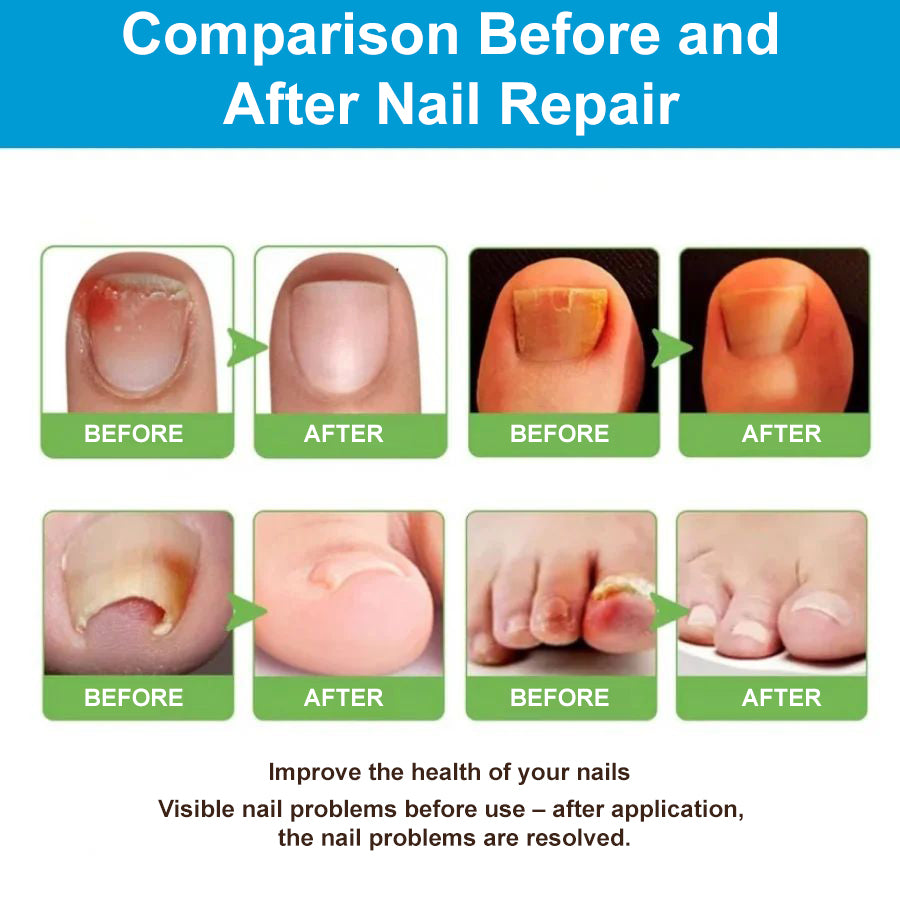 NailClear™
